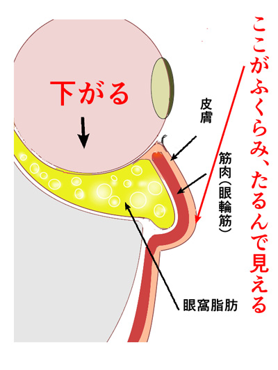 目の下のたるみがなぜできるのか説明した画像