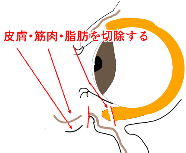 目の下のたるみ施術