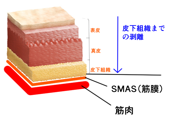 皮膚のみのフェイスリフトの解説画像