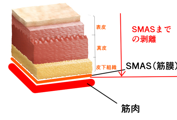 SMAS（スマス）リフトの概説画像