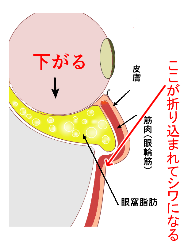 たるみが原因の目の下のシワの画像