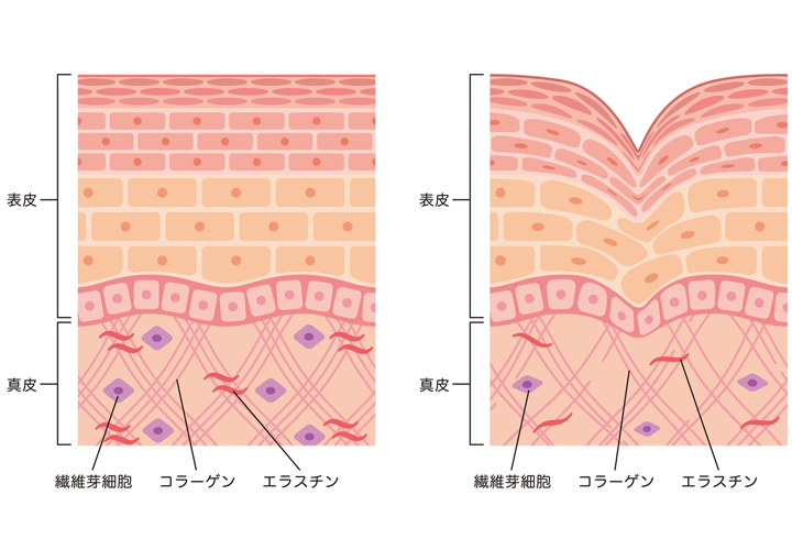 ほうれい線の肌の断面画像