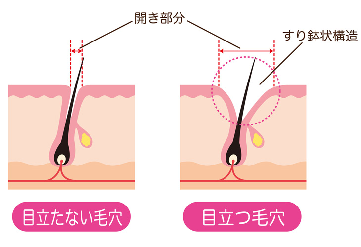 たるみ毛穴の解説画像