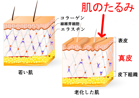 肌のたるみの解説画像