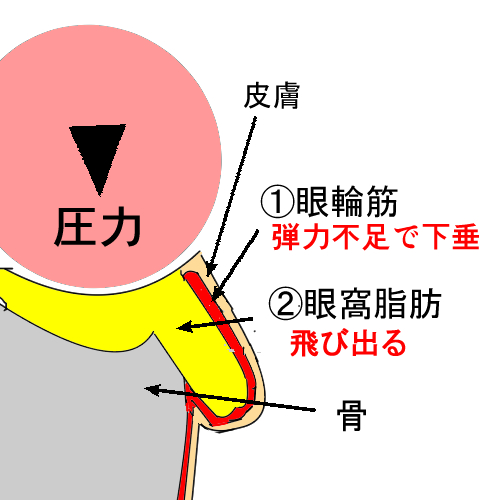 眼窩脂肪が飛び出るメカニズムの画像