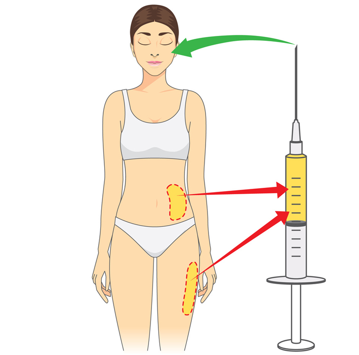 脂肪注入注射の画像