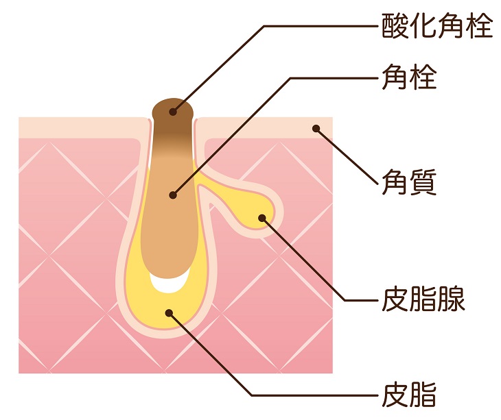 角栓で肌がザラザラの画像